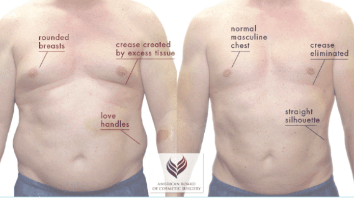Gynecomastia Blog